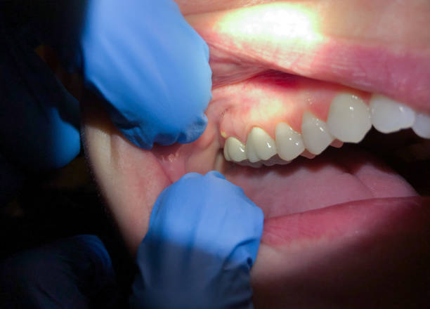 Best Emergency Dental Care for Broken or Chipped Teeth in Wyndham, VA
